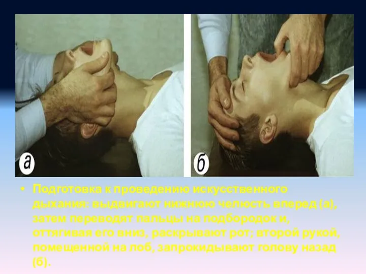 Подготовка к проведению искусственного дыхания: выдвигают нижнюю челюсть вперед (а), затем