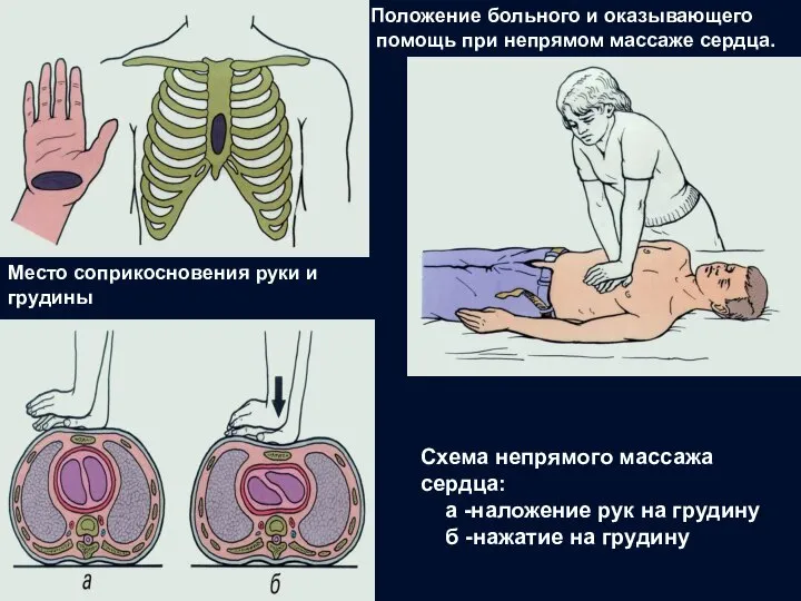 Место соприкосновения руки и грудины Положение больного и оказывающего помощь при