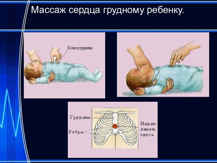 Массаж сердца грудному ребенку.