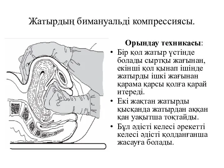 Жатырдың бимануальді компрессиясы. Орындау техникасы: Бір қол жатыр үстінде болады сыртқы