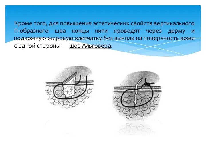 Кроме того, для повышения эстетических свойств вертикального П-образного шва концы нити