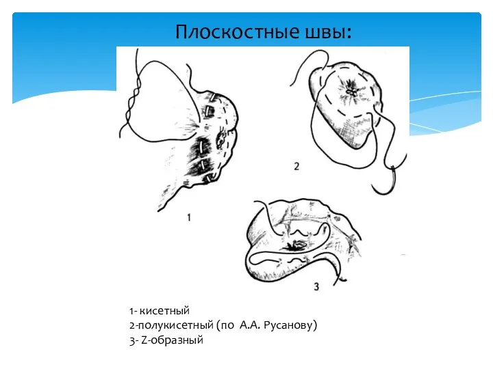 Плоскостные швы: 1- кисетный 2-полукисетный (по А.А. Русанову) 3- Z-образный