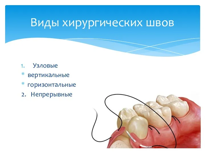 Узловые вертикальные горизонтальные 2. Непрерывные Виды хирургических швов