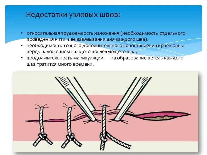 Недостатки узловых швов: относительная трудоемкость наложения (необходимость отдельного проведения нити и