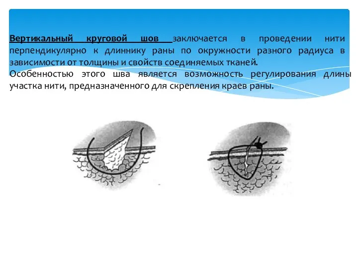 Вертикальный круговой шов заключается в проведении нити перпендикулярно к длиннику раны