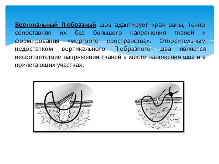 Вертикальный П-образный шов адаптирует края раны, точно сопоставляя их без большого