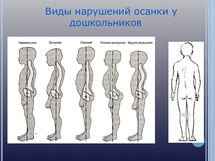 Виды нарушений осанки у дошкольников