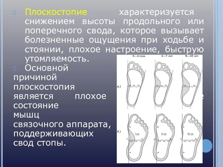 Плоскостопие характеризуется снижением высоты продольного или поперечного свода, которое вызывает болезненные