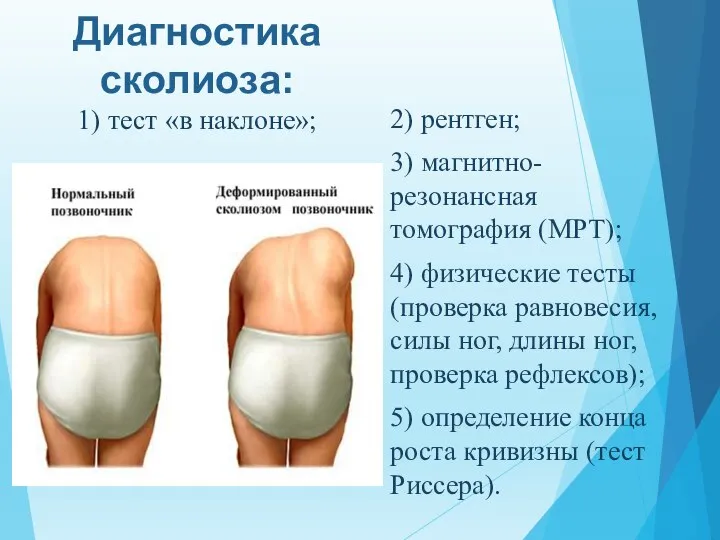 Диагностика сколиоза: 1) тест «в наклоне»; 2) рентген; 3) магнитно-резонансная томография