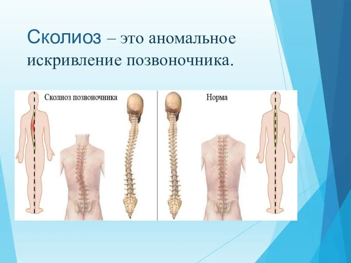 Сколиоз – это аномальное искривление позвоночника.