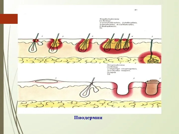 Пиодермии