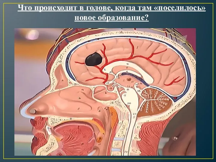 Что происходит в голове, когда там «поселилось» новое образование?