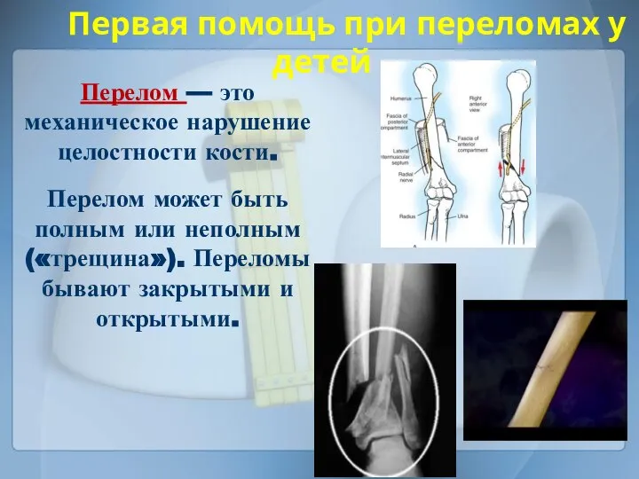 Перелом — это механическое нарушение целостности кости. Перелом может быть полным