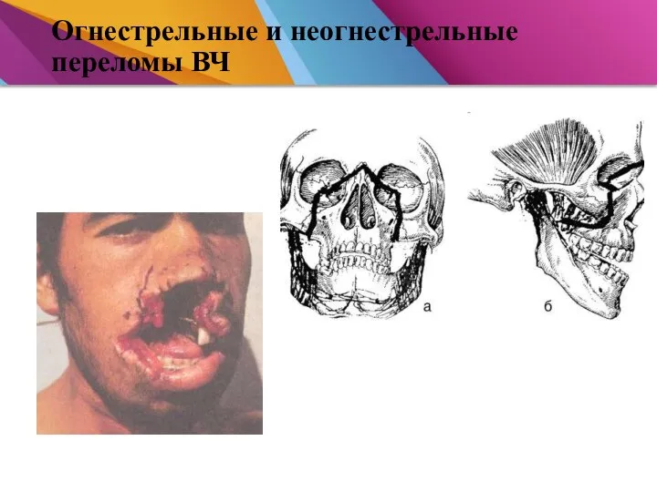 Огнестрельные и неогнестрельные переломы ВЧ