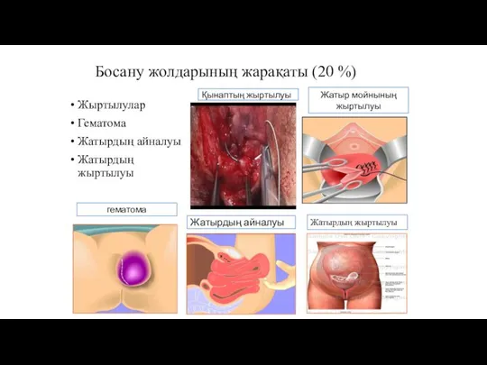 Босану жолдарының жарақаты (20 %) Жыртылулар Гематома Жатырдың айналуы Жатырдың жыртылуы