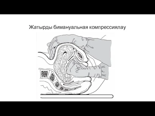 Жатырды бимануальная компрессиялау