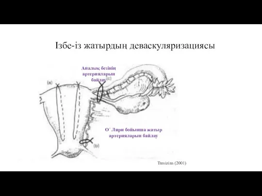 Ізбе-із жатырдың деваскуляризациясы Tamizian (2001) О´ Лири бойынша жатыр артерияларын байлау Аналық безінің артерияларын байлау