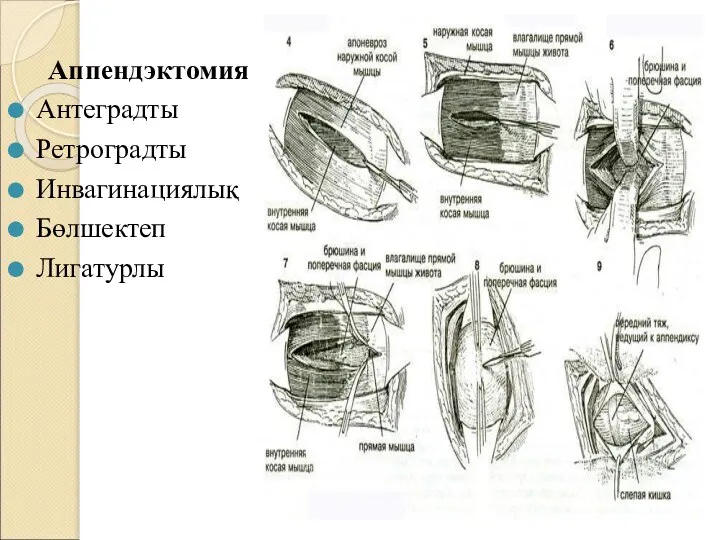 Аппендэктомия: Антеградты Ретроградты Инвагинациялық Бөлшектеп Лигатурлы