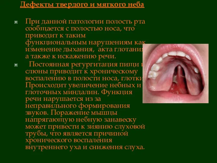 Дефекты твердого и мягкого неба При данной патологии полость рта сообщается