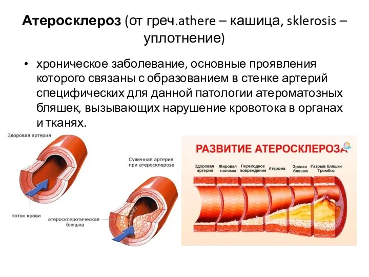 Атеросклероз (от греч.athere – кашица, sklerosis – уплотнение) хроническое заболевание, основные