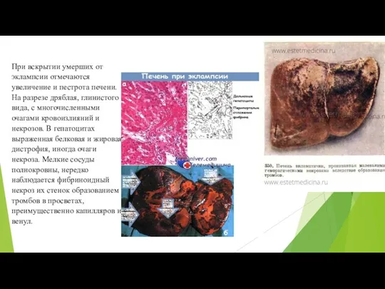 При вскрытии умерших от эклампсии отмечаются увеличение и пестрота печени. На