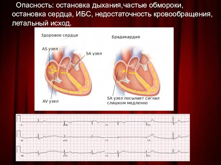 Опасность: остановка дыхания,частые обмороки, остановка сердца, ИБС, недостаточность кровообращения, летальный исход.