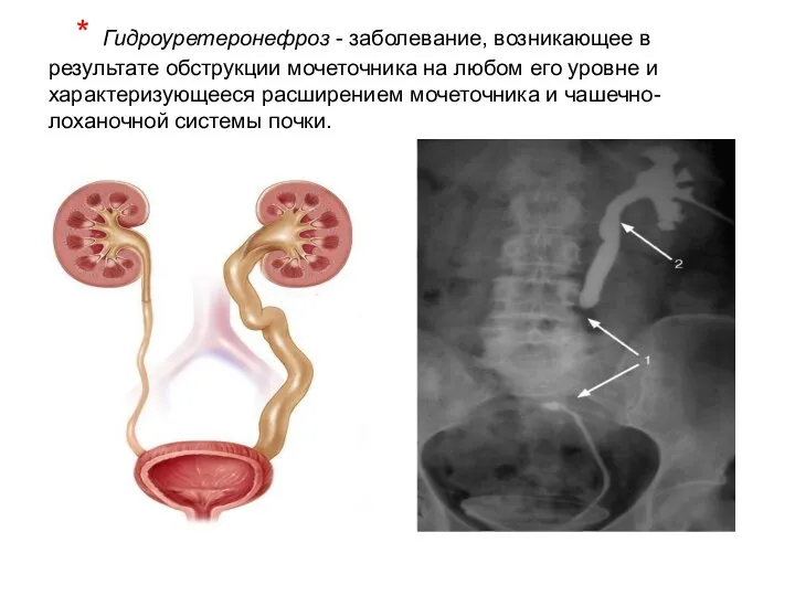 * Гидроуретеронефроз - заболевание, возникающее в результате обструкции мочеточника на любом