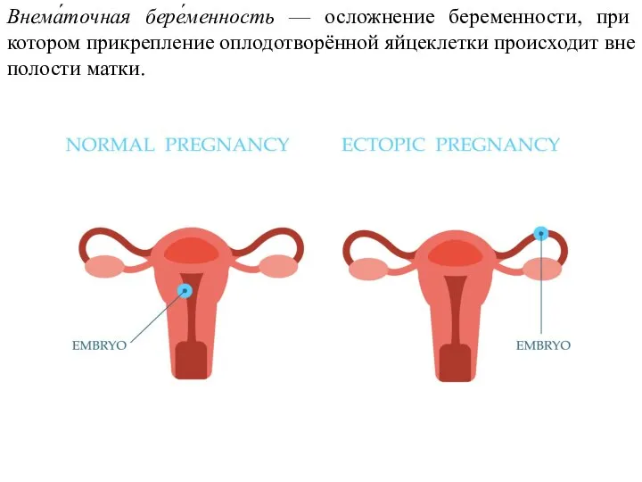 Внема́точная бере́менность — осложнение беременности, при котором прикрепление оплодотворённой яйцеклетки происходит вне полости матки.