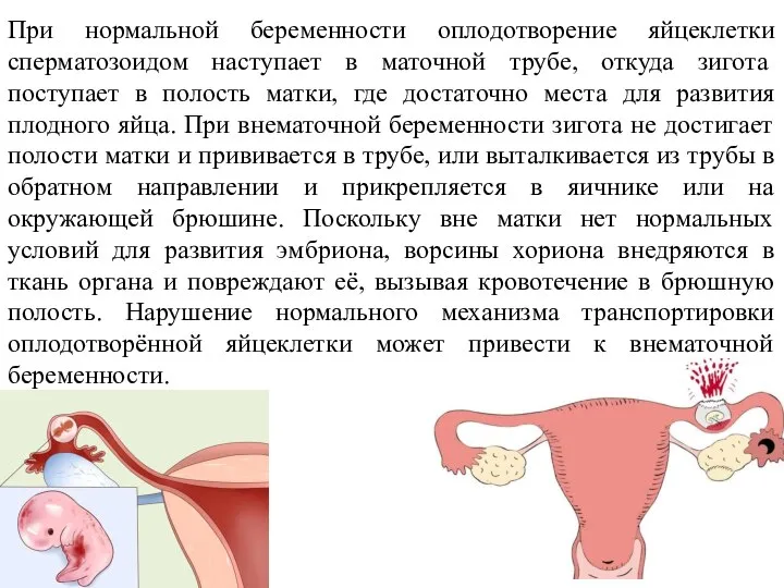 При нормальной беременности оплодотворение яйцеклетки сперматозоидом наступает в маточной трубе, откуда