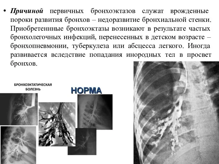 Причиной первичных бронхоэктазов служат врожденные пороки развития бронхов – недоразвитие бронхиальной