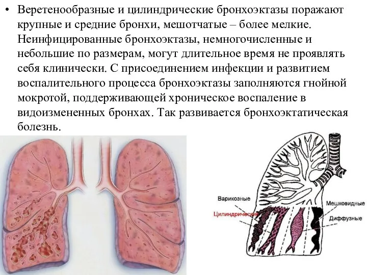 Веретенообразные и цилиндрические бронхоэктазы поражают крупные и средние бронхи, мешотчатые –