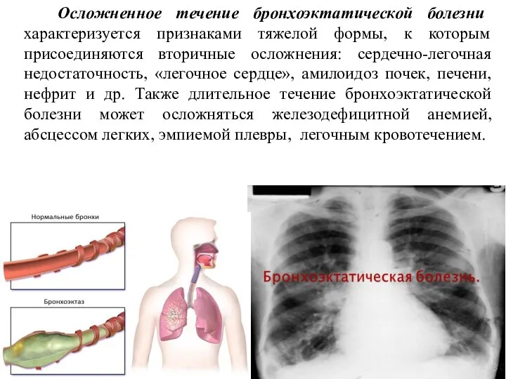 Осложненное течение бронхоэктатической болезни характеризуется признаками тяжелой формы, к которым присоединяются