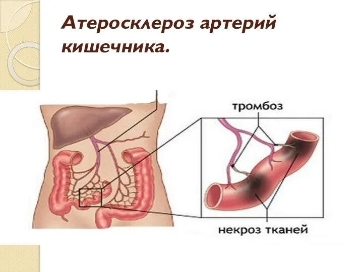 Атеросклероз артерий кишечника.