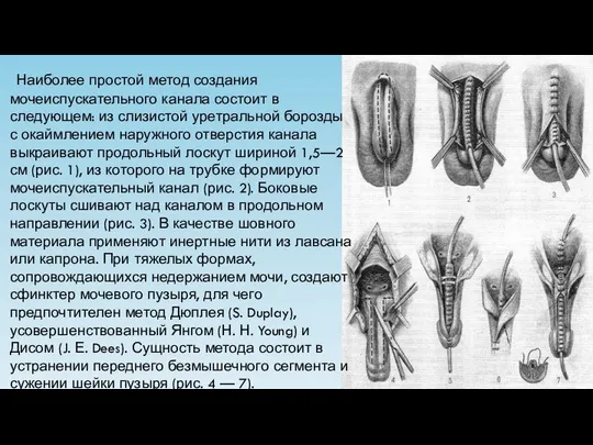 Наиболее простой метод создания мочеиспускательного канала состоит в следующем: из слизистой