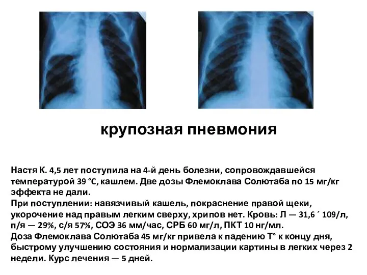 Настя К. 4,5 лет поступила на 4-й день болезни, сопровождавшейся температурой