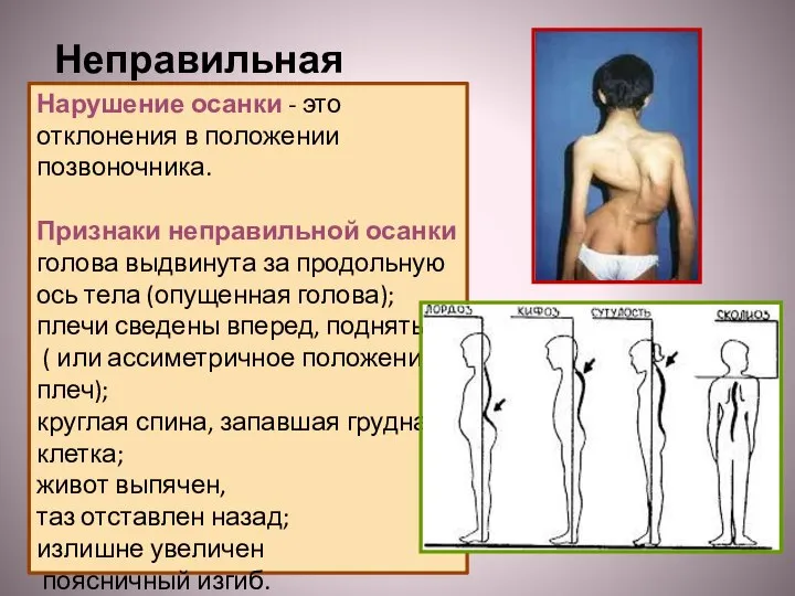 Неправильная осанка Нарушение осанки - это отклонения в положении позвоночника. Признаки