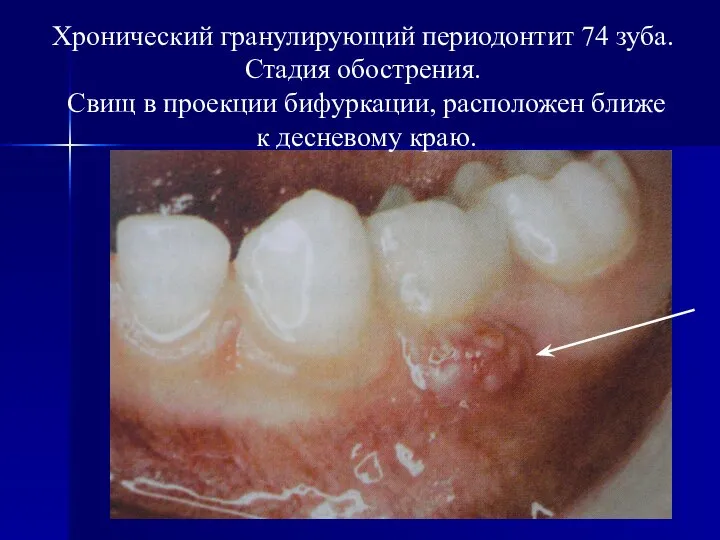 Хронический гранулирующий периодонтит 74 зуба. Стадия обострения. Свищ в проекции бифуркации, расположен ближе к десневому краю.