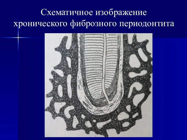 Схематичное изображение хронического фиброзного периодонтита