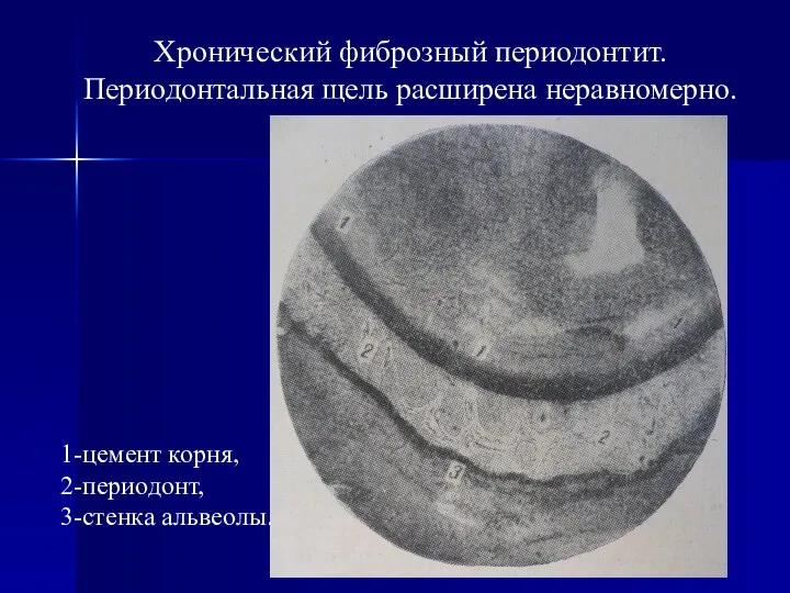 1-цемент корня, 2-периодонт, 3-стенка альвеолы. Хронический фиброзный периодонтит. Периодонтальная щель расширена неравномерно.