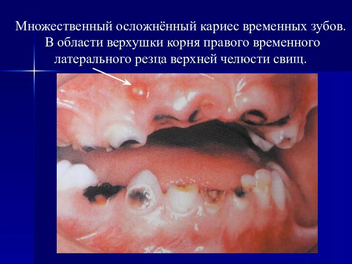 Множественный осложнённый кариес временных зубов. В области верхушки корня правого временного латерального резца верхней челюсти свищ.