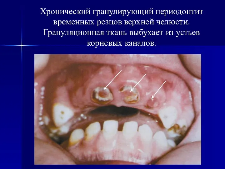 Хронический гранулирующий периодонтит временных резцов верхней челюсти. Грануляционная ткань выбухает из устьев корневых каналов.