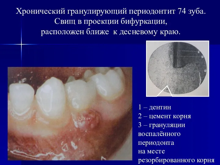 Хронический гранулирующий периодонтит 74 зуба. Свищ в проекции бифуркации, расположен ближе