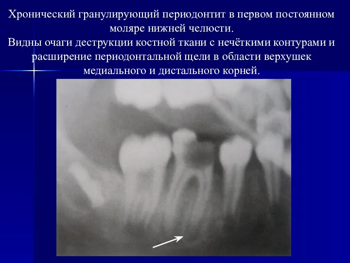 Хронический гранулирующий периодонтит в первом постоянном моляре нижней челюсти. Видны очаги