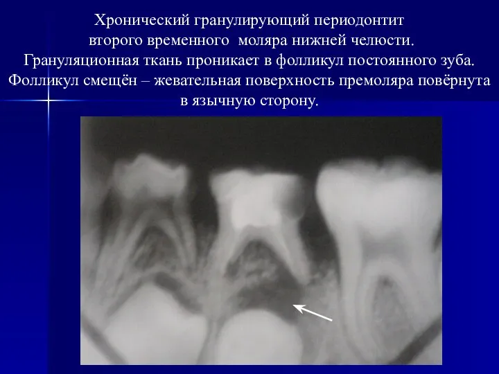 Хронический гранулирующий периодонтит второго временного моляра нижней челюсти. Грануляционная ткань проникает