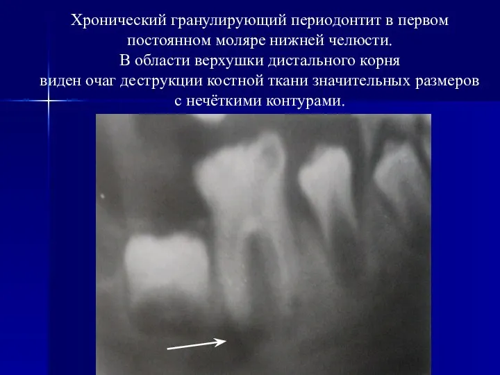 Хронический гранулирующий периодонтит в первом постоянном моляре нижней челюсти. В области