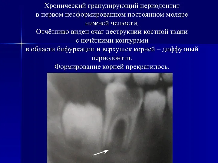 Хронический гранулирующий периодонтит в первом несформированном постоянном моляре нижней челюсти. Отчётливо
