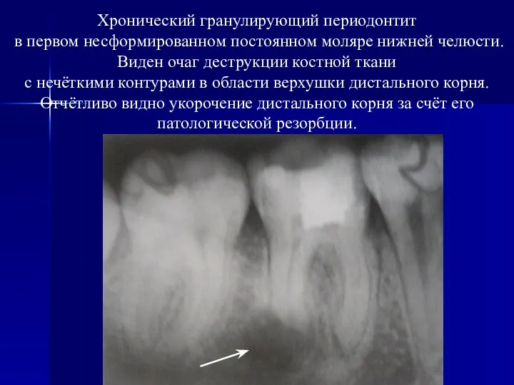 Хронический гранулирующий периодонтит в первом несформированном постоянном моляре нижней челюсти. Виден