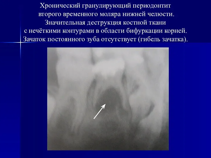 Хронический гранулирующий периодонтит второго временного моляра нижней челюсти. Значительная деструкция костной