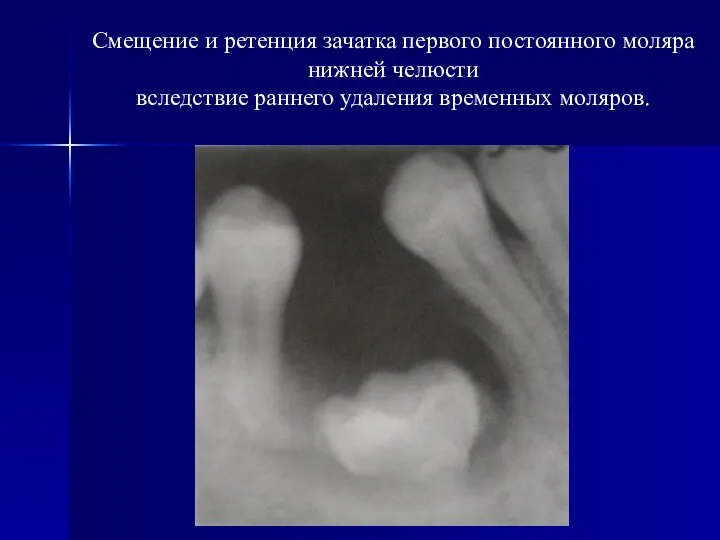 Смещение и ретенция зачатка первого постоянного моляра нижней челюсти вследствие раннего удаления временных моляров.