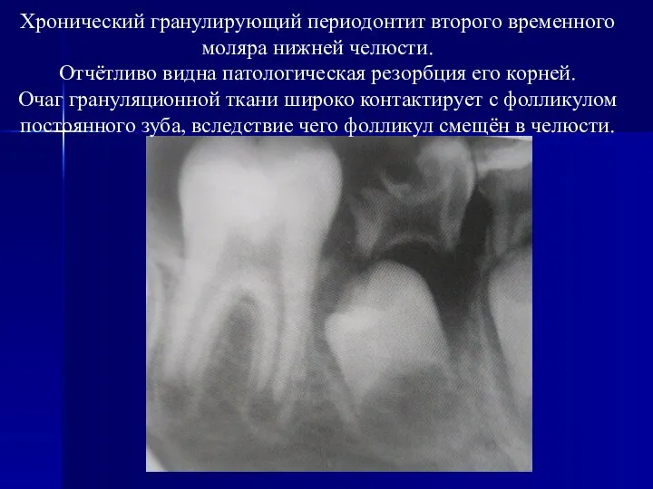 Хронический гранулирующий периодонтит второго временного моляра нижней челюсти. Отчётливо видна патологическая
